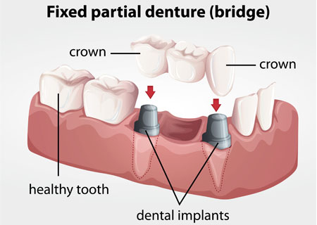 Bridges | Potomac Dental Clinic
